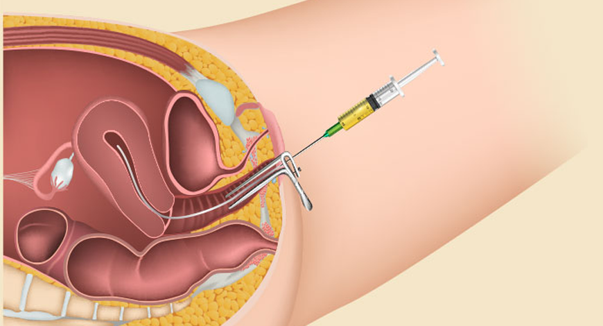 Embryo transfer procedure explanation