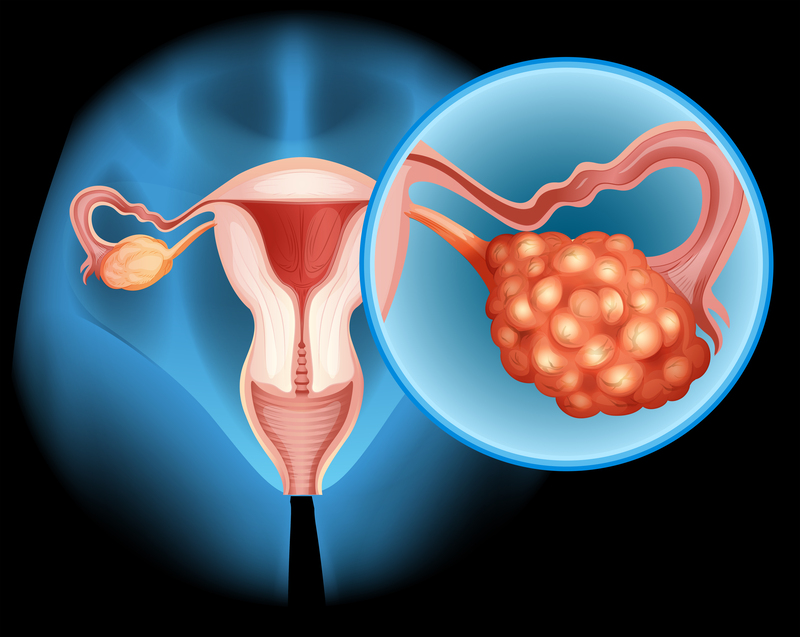 endometriotic cyst in ovary